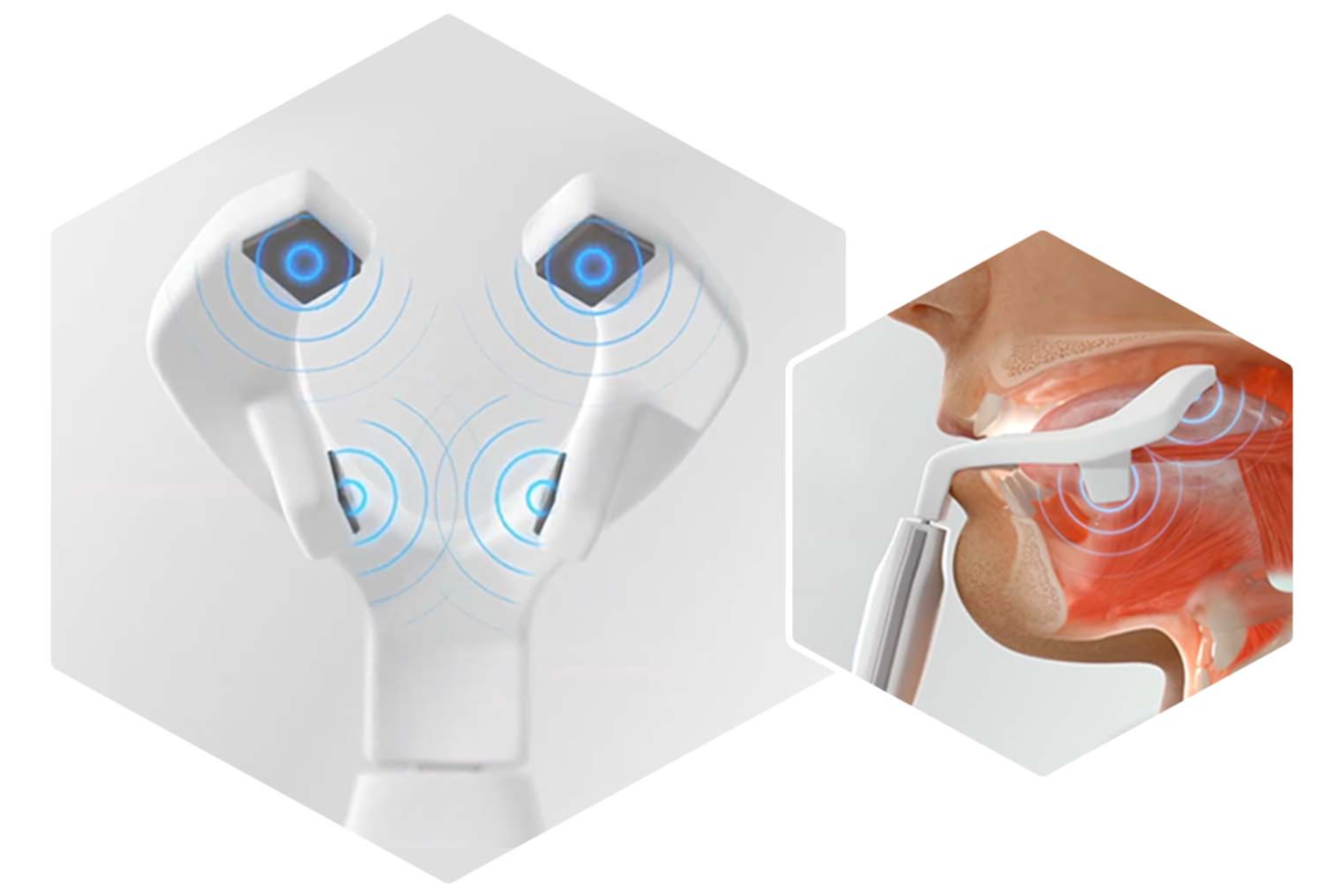 eXciteOSA uses NMES technology for targeted therapy to tone tongue muscles and reduce snoring.
